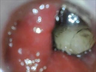 anal endoscope pain in the neck carry on from inside
